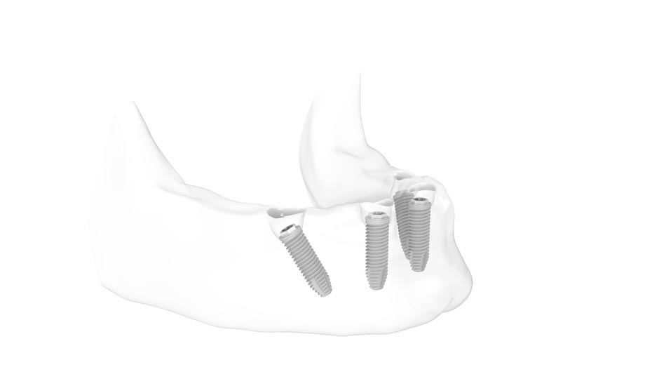 All-on-4: festsitzender Zahnersatz auf 4 Implantaten