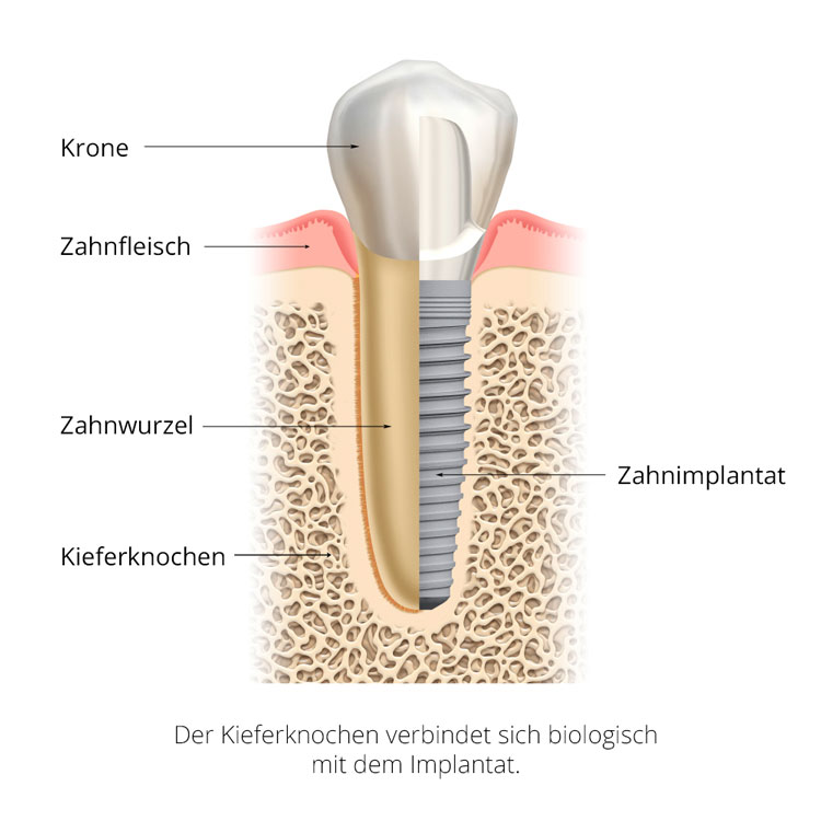 Zahnimplantate ersetzen die natürliche Zahnwurzel